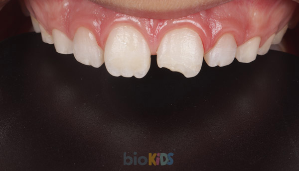 dentisteria-odontopediatrica-traumatologia-antes