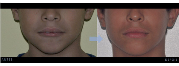 Caso Clínico 1: Ortodontia miofuncional para auxílio na aquisição de um bom selamento labial, melhoramento da musculatura peri-oral, padrão de deglutição e postura labial em repouso numa criança de 7 anos de idade